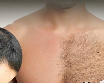 La greffe de cheveux est-elle faite à partir des poils du corps?