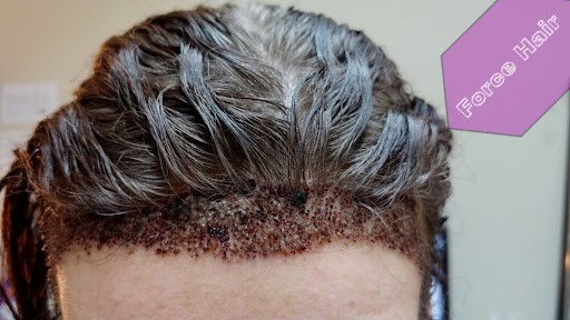Quelles sont les causes de la formation de croûtes après une greffe de cheveux?