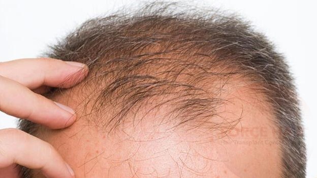 Androgenetik Alopesi