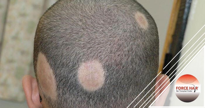 Simptomele alopeciei (căderea părului)