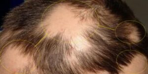 Alopesi Totalis