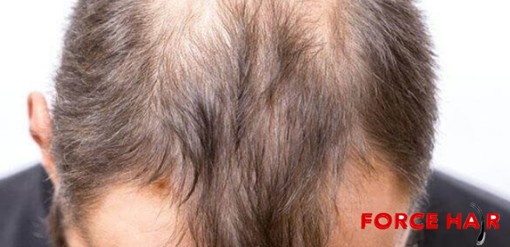 Erkek Tipi Saç Dökülmesi; Androgenetik Alopesi