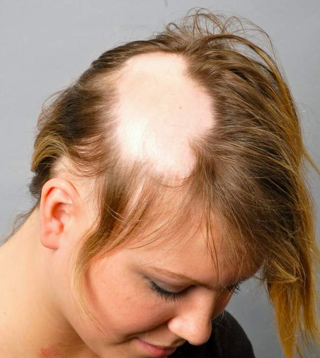 Alopesi Areata