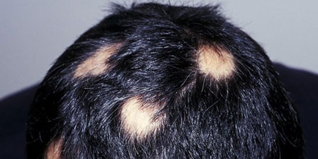 Alopesi Areata